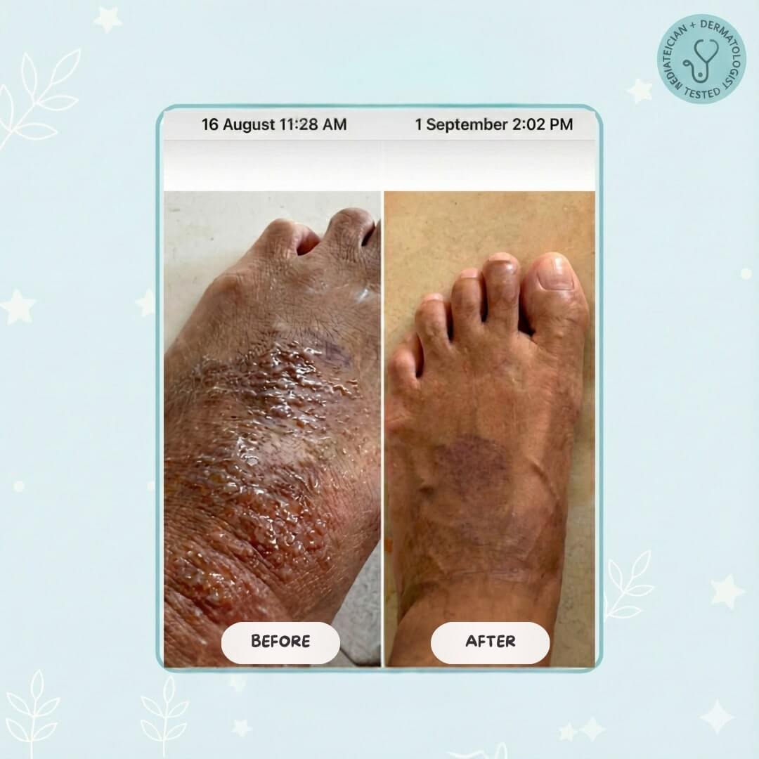 Baby Eczema Beef Tallow Balm