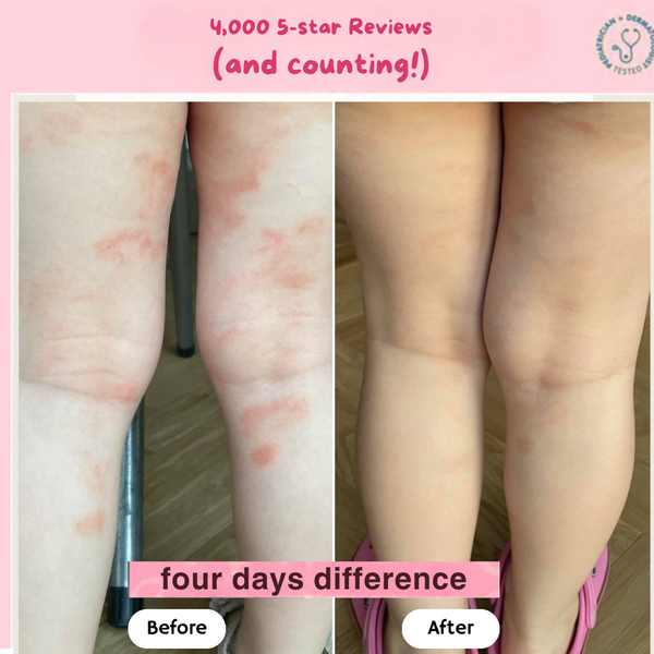 Baby Eczema Beef Tallow Balm