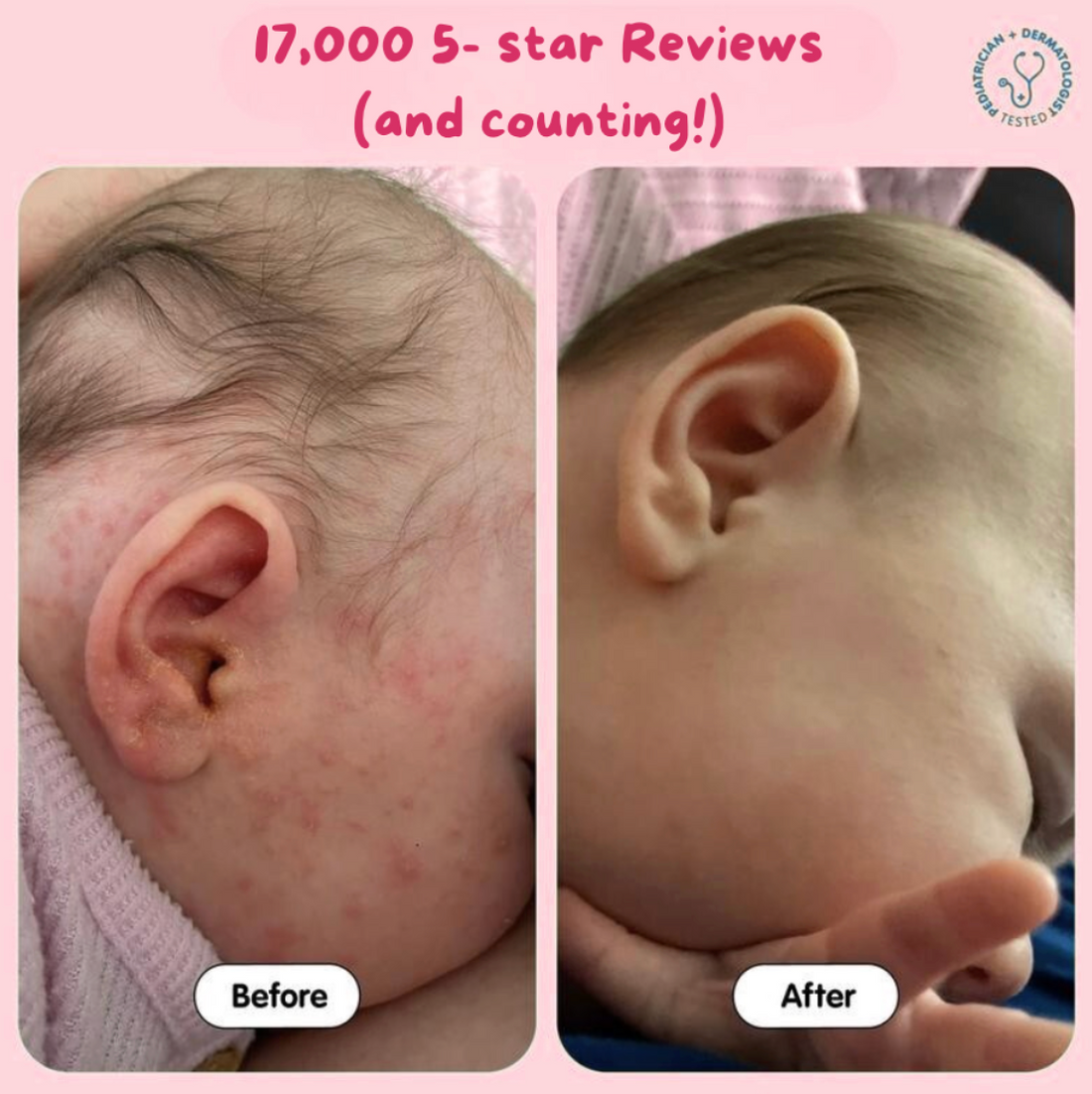 Baby Eczema Beef Tallow Balm