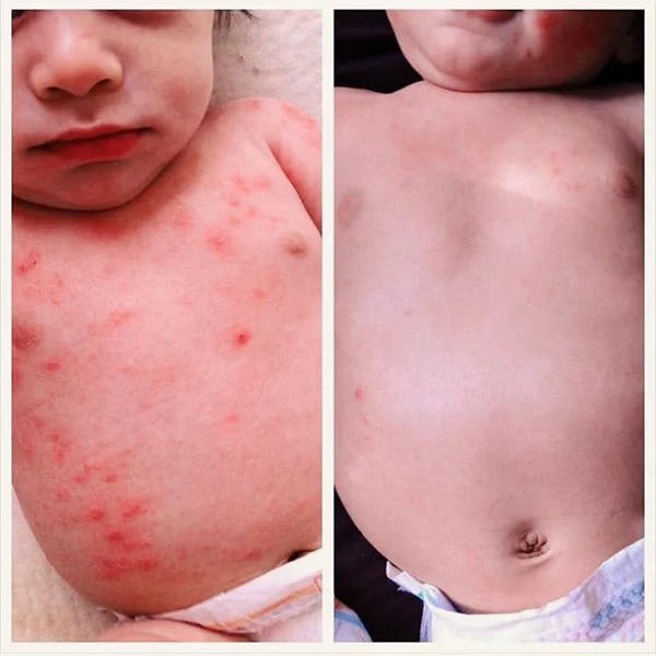 Baby Eczema Beef Tallow Balm